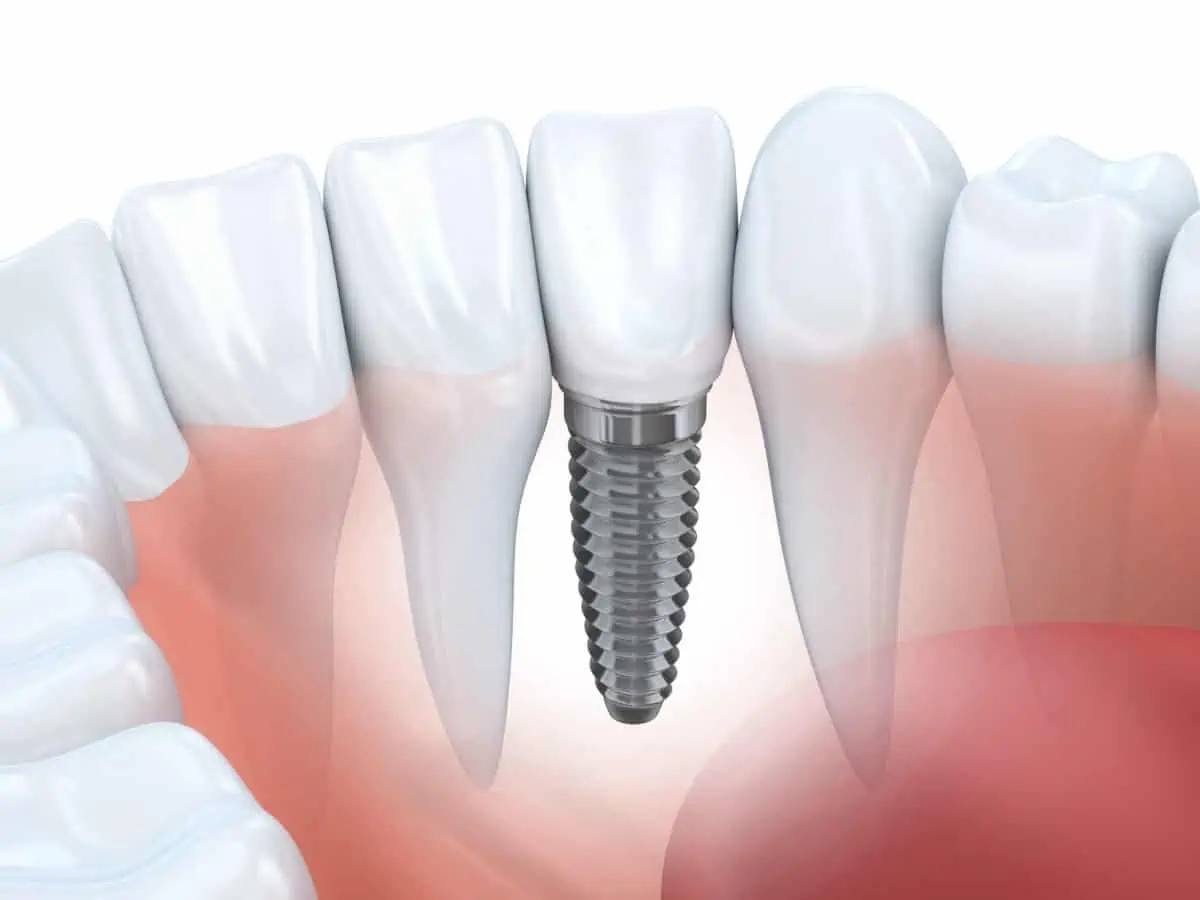 Implantate